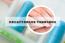 傷寒論治療牛皮癬在后背 牛皮膚癬中醫(yī)辯證