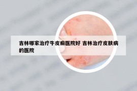 吉林哪家治療牛皮癬醫(yī)院好 吉林治療皮膚病的醫(yī)院