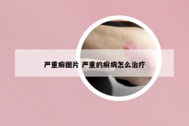 嚴重癬圖片 嚴重的癬病怎么治療