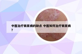 中醫(yī)治療銀屑病的缺點(diǎn) 中醫(yī)如何治療銀屑病?
