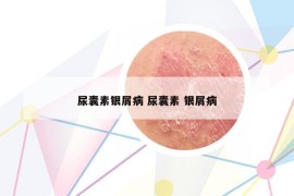 尿囊素銀屑病 尿囊素 銀屑病