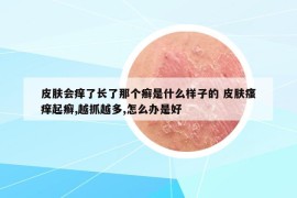 皮膚會(huì)癢了長了那個(gè)癬是什么樣子的 皮膚瘙癢起癬,越抓越多,怎么辦是好