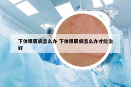 下體銀屑病怎么辦 下體銀屑病怎么辦才能治好