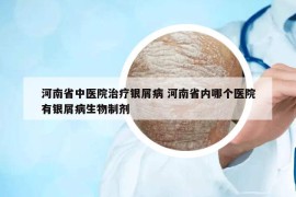河南省中醫(yī)院治療銀屑病 河南省內(nèi)哪個醫(yī)院有銀屑病生物制劑