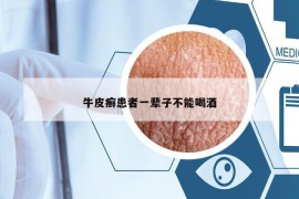 牛皮癬患者一輩子不能喝酒