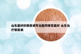 山東最好的銀屑病專治醫(yī)院哪家最好 山東治療銀屑病