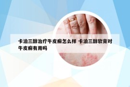卡泊三醇治療牛皮癬怎么樣 卡泊三醇軟膏對牛皮癬有用嗎