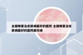 全國哪里治皮膚病最好的醫(yī)院 全國哪里治皮膚病最好的醫(yī)院最權(quán)威
