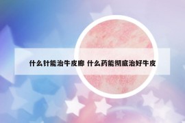 什么針能治牛皮廊 什么藥能徹底治好牛皮