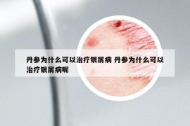 丹參為什么可以治療銀屑病 丹參為什么可以治療銀屑病呢