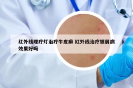 紅外線理療燈治療牛皮癬 紅外線治療銀屑病效果好嗎