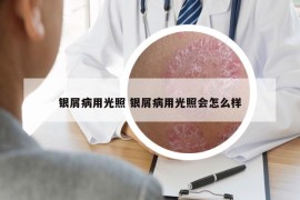 銀屑病用光照 銀屑病用光照會(huì)怎么樣
