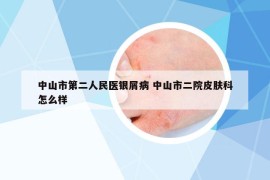 中山市第二人民醫(yī)銀屑病 中山市二院皮膚科怎么樣