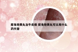 犀角地黃丸治牛皮癬 犀角地黃丸可以用什么藥代替