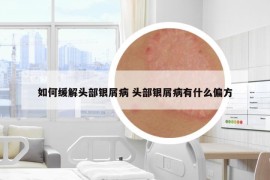如何緩解頭部銀屑病 頭部銀屑病有什么偏方