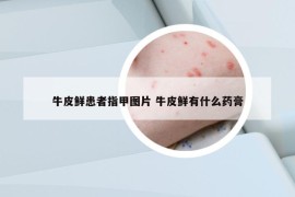 牛皮鮮患者指甲圖片 牛皮鮮有什么藥膏
