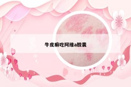 牛皮癬吃阿維a膠囊