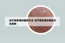 治療銀屑病的最新方法 治療銀屑病的最新方法視頻