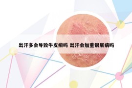 出汗多會導(dǎo)致牛皮癬嗎 出汗會加重銀屑病嗎