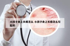 小孩子身上長(zhǎng)癬怎么 小孩子身上長(zhǎng)癬怎么引起的