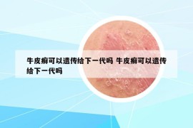 牛皮癬可以遺傳給下一代嗎 牛皮癬可以遺傳給下一代嗎