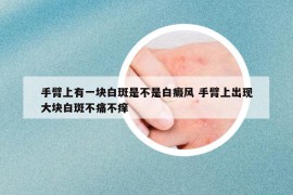 手臂上有一塊白斑是不是白癜風(fēng) 手臂上出現(xiàn)大塊白斑不痛不癢