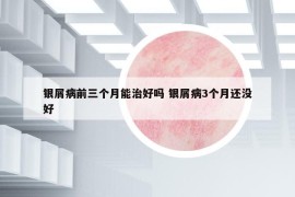 銀屑病前三個(gè)月能治好嗎 銀屑病3個(gè)月還沒(méi)好