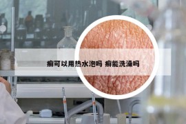 癬可以用熱水泡嗎 癬能洗澡嗎