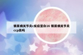 銀屑病關(guān)節(jié)炎c反應(yīng)蛋白16 銀屑病關(guān)節(jié)炎ccp高嗎
