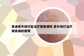 普通紫外線燈能治療銀屑病嗎 紫外線燈治療銀屑病的原理