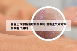藿香正氣水能治療銀屑病嗎 藿香正氣水對(duì)銀屑病有作用嗎