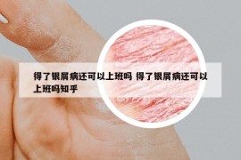 得了銀屑病還可以上班嗎 得了銀屑病還可以上班嗎知乎