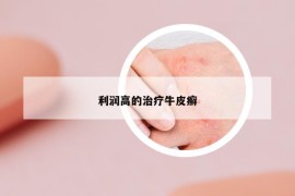 利潤高的治療牛皮癬