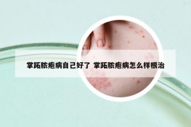 掌跖膿皰病自己好了 掌跖膿皰病怎么樣根治