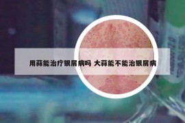 用蒜能治療銀屑病嗎 大蒜能不能治銀屑病
