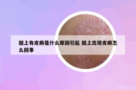 腿上有皮癬是什么原因引起 腿上出現(xiàn)皮癬怎么回事