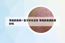 掌跖膿皰病一直不好會(huì)怎樣 掌跖膿皰病能看好嗎