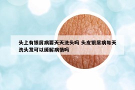 頭上有銀屑病要天天洗頭嗎 頭皮銀屑病每天洗頭發(fā)可以緩解病情嗎