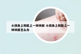 小孩身上和臉上一塊塊蘚 小孩身上和臉上一塊塊蘚怎么辦