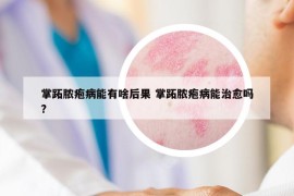 掌跖膿皰病能有啥后果 掌跖膿皰病能治愈嗎?