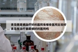 青島銀屑病治療好的醫(yī)院有哪些醫(yī)院比較好 青島有治療銀屑病好的醫(yī)院嗎