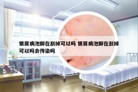 銀屑病泡腳在刮掉可以嗎 銀屑病泡腳在刮掉可以嗎會(huì)傳染嗎
