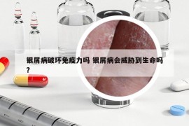 銀屑病破壞免疫力嗎 銀屑病會(huì)威脅到生命嗎?