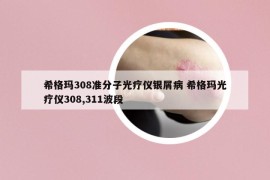 希格瑪308準(zhǔn)分子光療儀銀屑病 希格瑪光療儀308,311波段