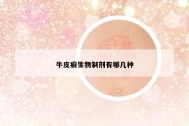 牛皮癬生物制劑有哪幾種