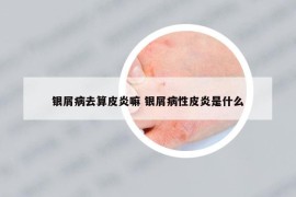 銀屑病去算皮炎嘛 銀屑病性皮炎是什么