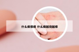 什么癬很癢 什么癬越撓越癢