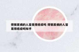 得銀屑病的人容易得癌癥嗎 得銀屑病的人容易得癌癥嗎知乎