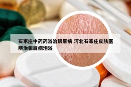 石家莊中藥藥浴治銀屑病 河北石家莊皮膚醫(yī)院治銀屑病泡浴