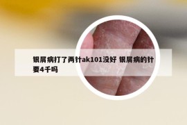 銀屑病打了兩針ak101沒(méi)好 銀屑病的針要4千嗎